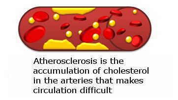 Bad cholesterol