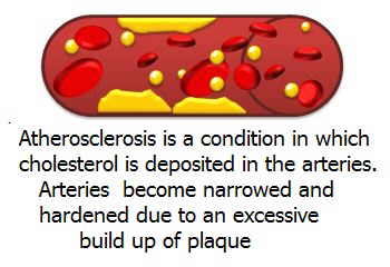 atheroma