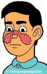 Malar erythema