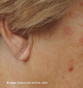 skin spots