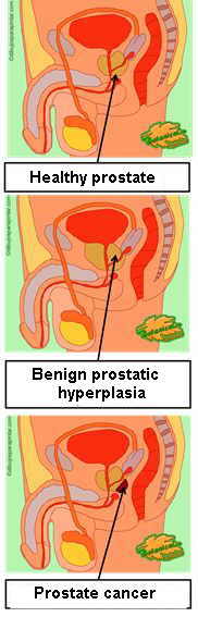 Drawing of prostate diseases