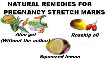 remedies stretch marks pregnancy creams recommended oils