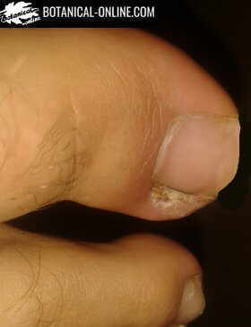 ingrown nail