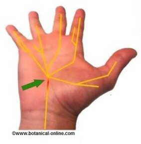 Carpal tunnel syndrome
