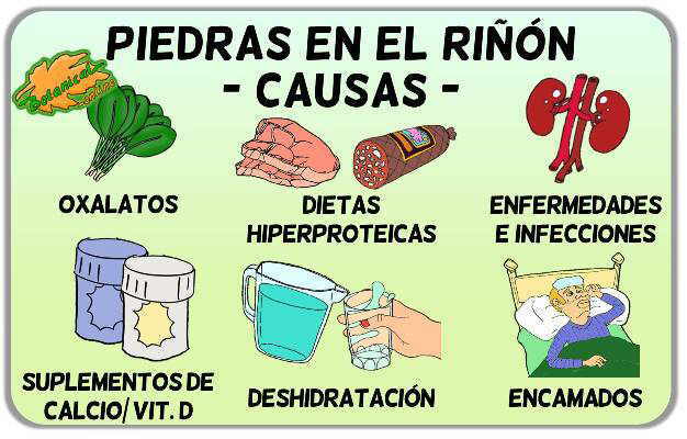tratamiento natural de las piedras en el riñón