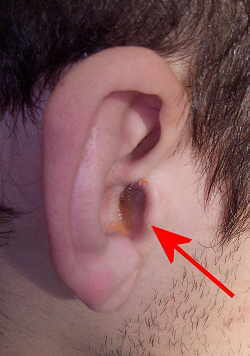 pus de la oreja
