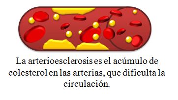 arteriosclerosis