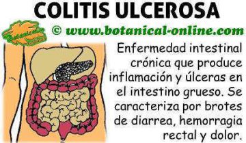 colitis ulcerosa que es