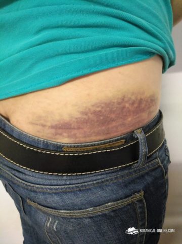 Hematoma