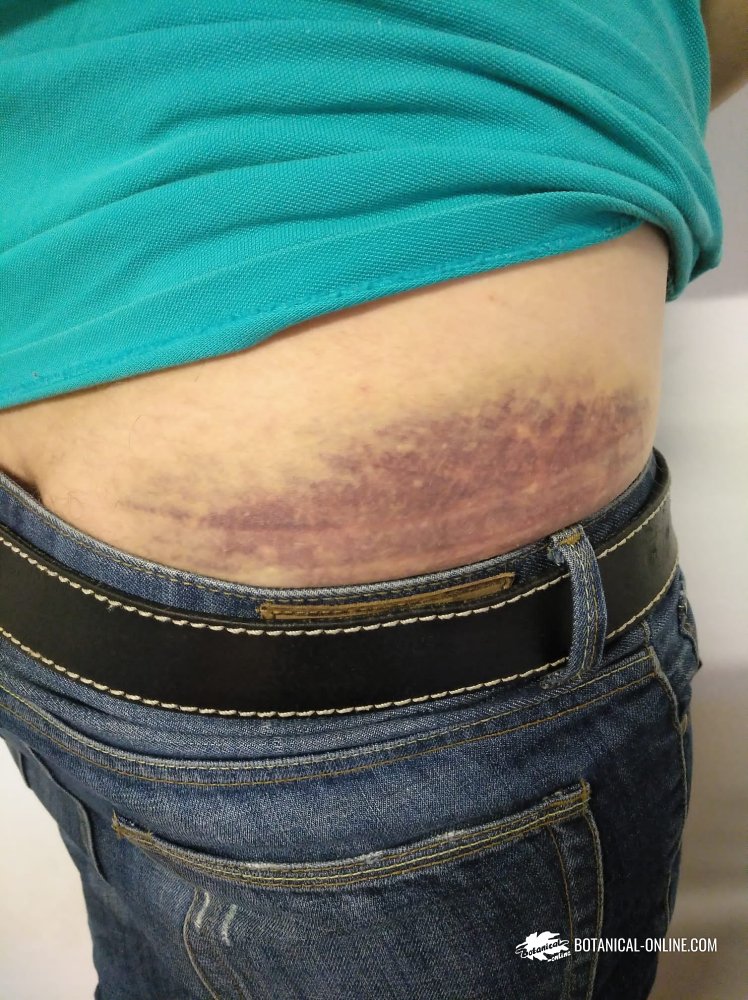 hematomas sin causa