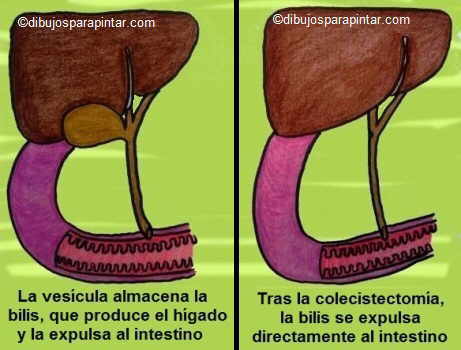 colecistectomia extirpacion vesicula remedios