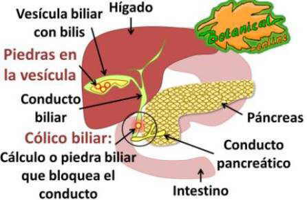 Dieta para la vesicula inflamada