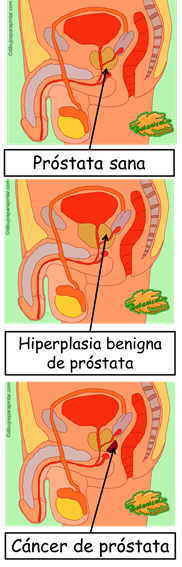 la prostata enfermedades